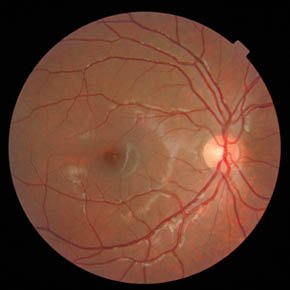 MACULAR DEGENERATION