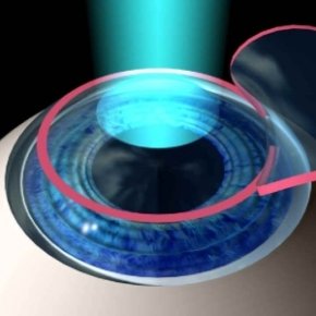 REFRACTIVE SURGERY
