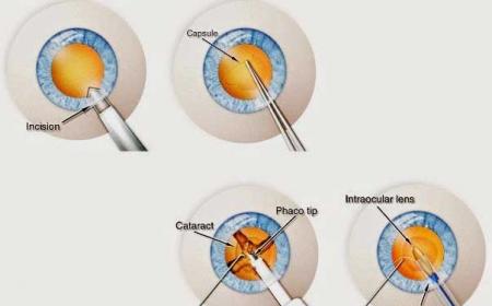 ΕΓΧΕΙΡΗΣΗ ΚΑΤΑΡΡΑΚΤΗ Πρέπει να καθυστερήσω την επέμβαση του καταρράκτη-1