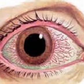 CONJUCTIVITIS