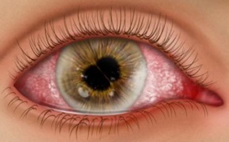UVEITIS-1