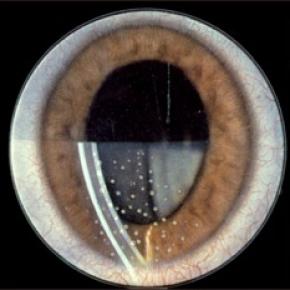 UVEITIS