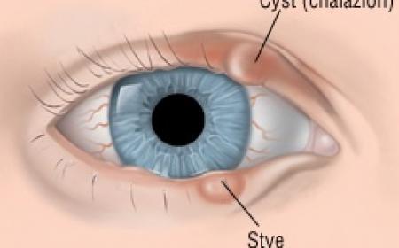 Chalazion-1