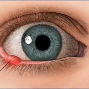 Chalazion