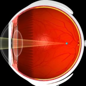 MYOPIA