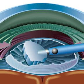 Cataract