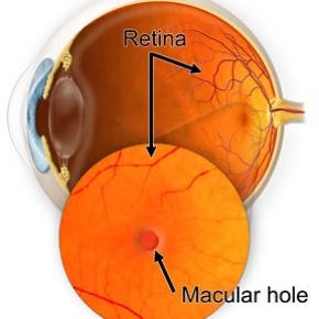 MACULAR HOLE