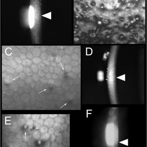 FUCHS DYSTROPHY