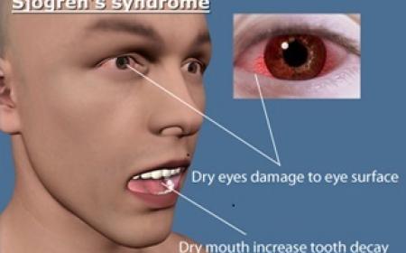 SJOGRENS SYNDROME-1