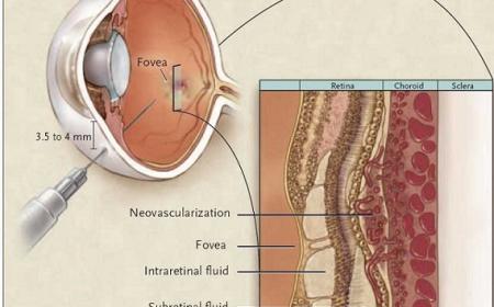abnormalities or diseases affecting the blood vessels in the retina-1