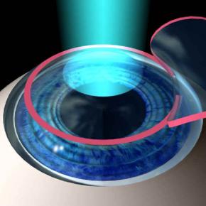 LASIK /TRANS-PRK