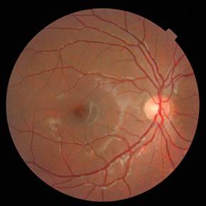 AGE RELATED MACULAR DEGENERATION