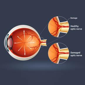 Glaucoma