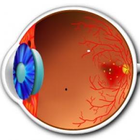 Diabetic Retinopathy