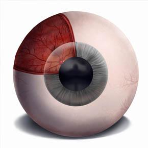 Retinal Detachment
